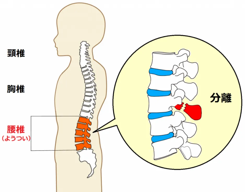 腰椎分離症について