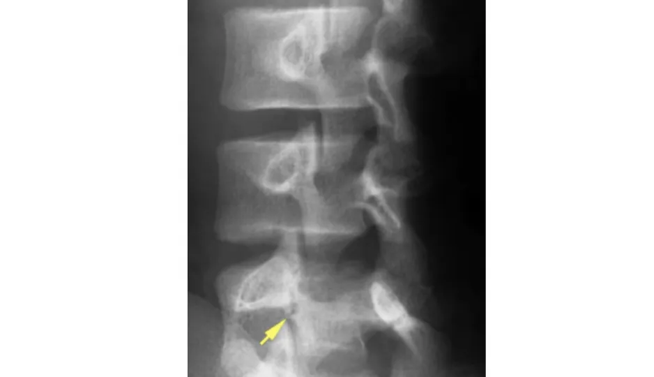 腰痛分離症の診断