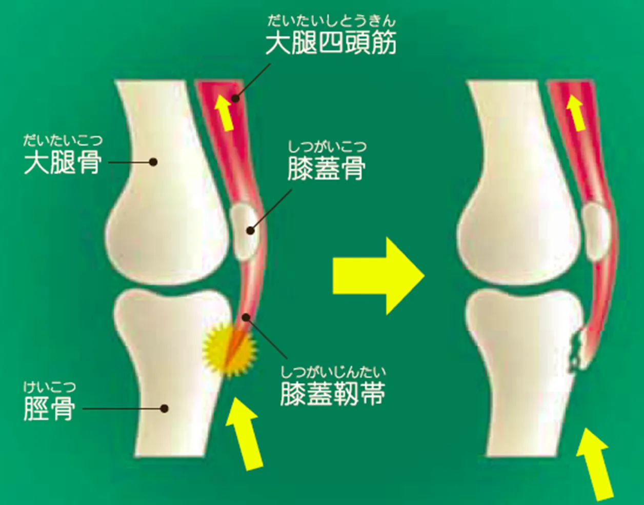膝関節の痛み(オスグッド・シュラッター病)の説明