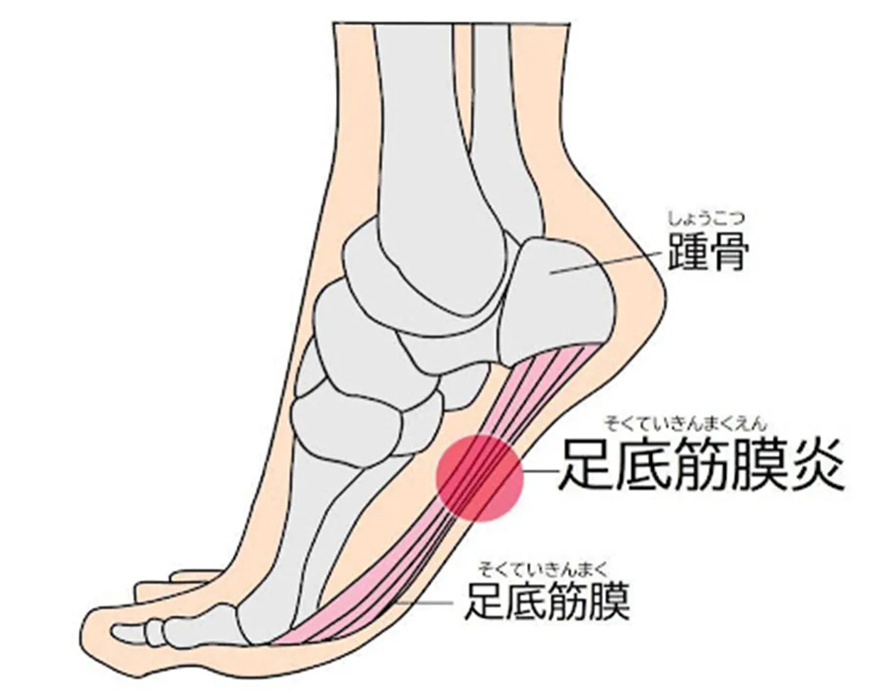 足底筋膜炎について